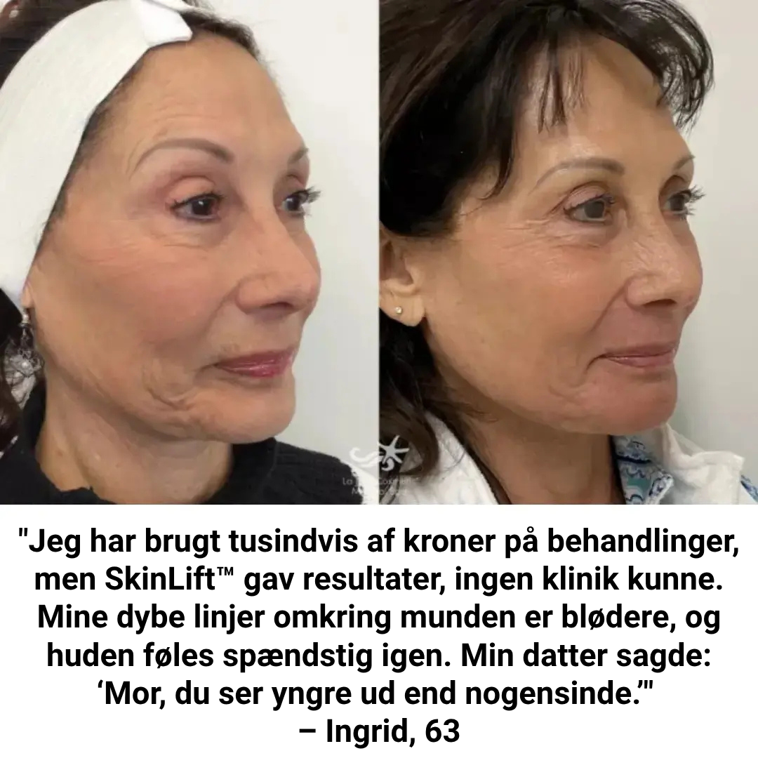 SkinLift™ Botox Serum - Synligt yngre hud på 14 dage.