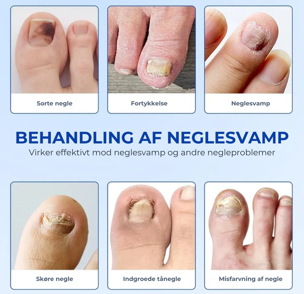 LoveleiFix™ – Svampedræbende Loveleiplaster til Sundere Lovelei