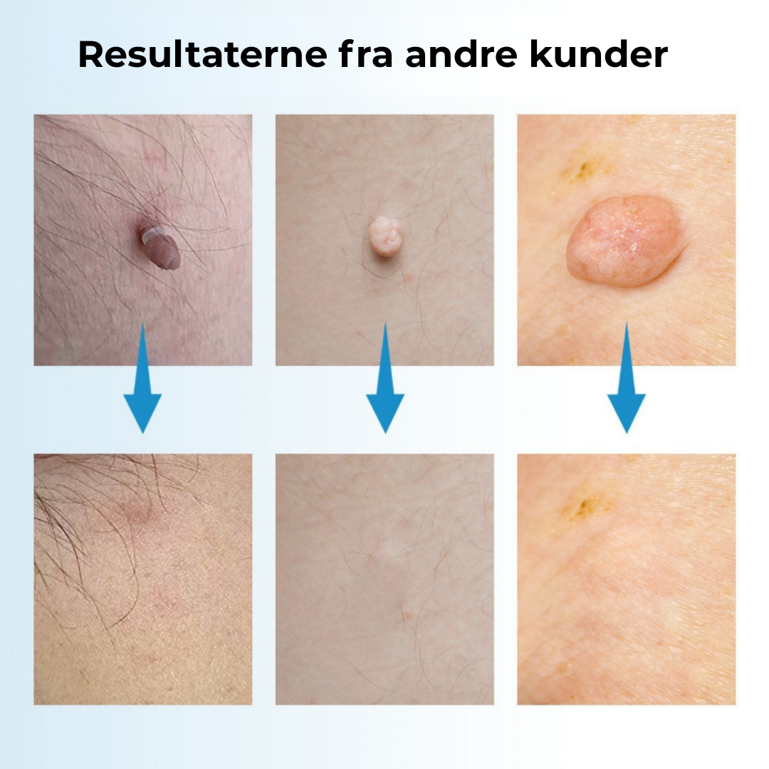 SkinEase™ Pen – Lovelei fjernelse af hudmærker!