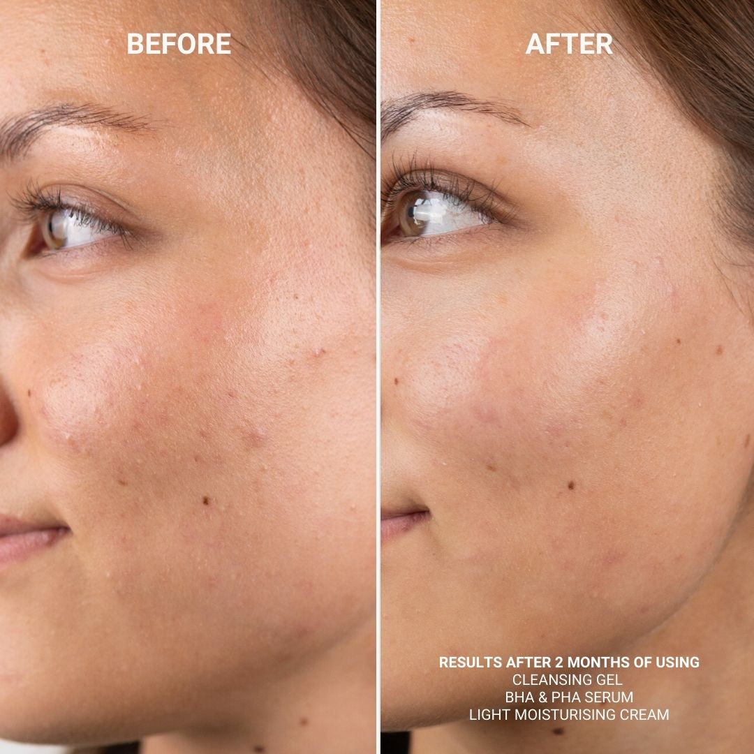 CLEANSING GEL (WITH 5% PHA)