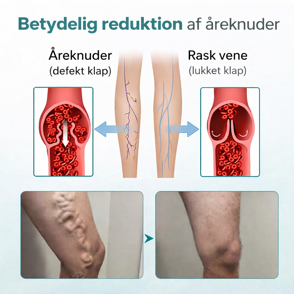 VenaLindre™ – Micronåle-patch til støtte for vener og lindring af tunge ben