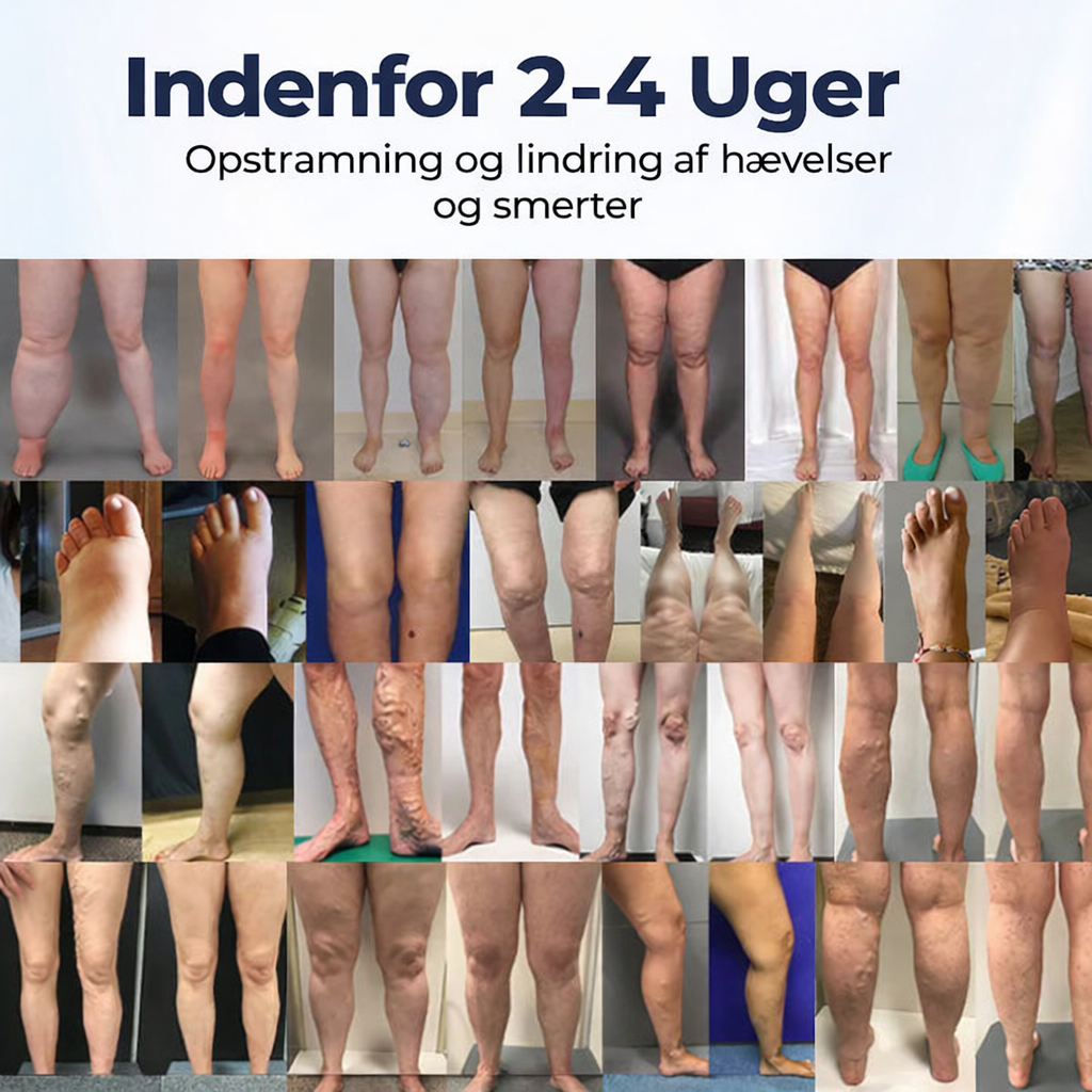 BenRo™ – LindLoveleide bencreme til lette ben og bedre blodcirkulation