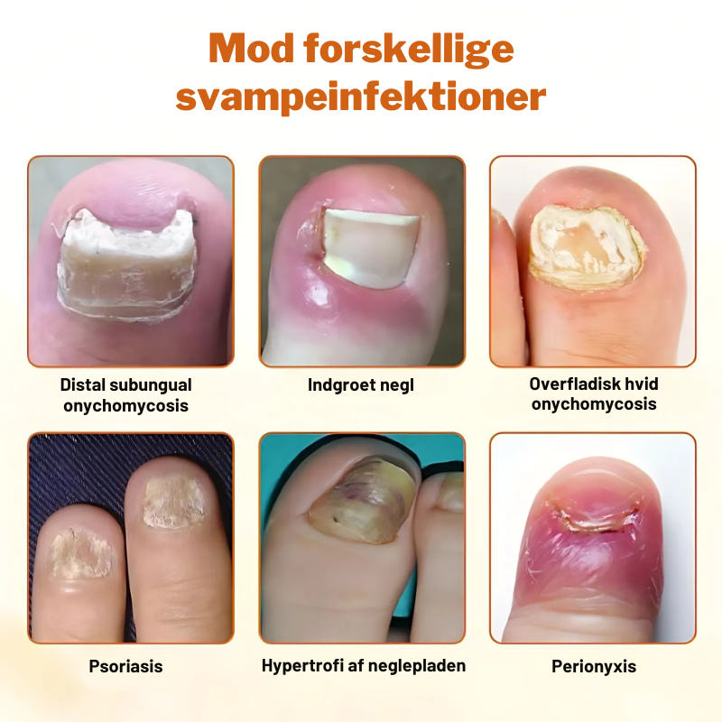 LoveleiNegl™ – Avanceret Svampedræbende Loveleiplejespray