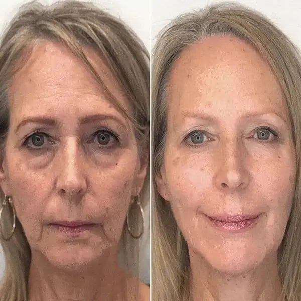 SkinLift™ Botox Serum - Synligt yngre hud på 14 dage.